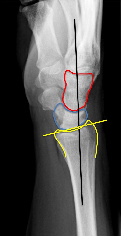 Wrist Anatomy Xray